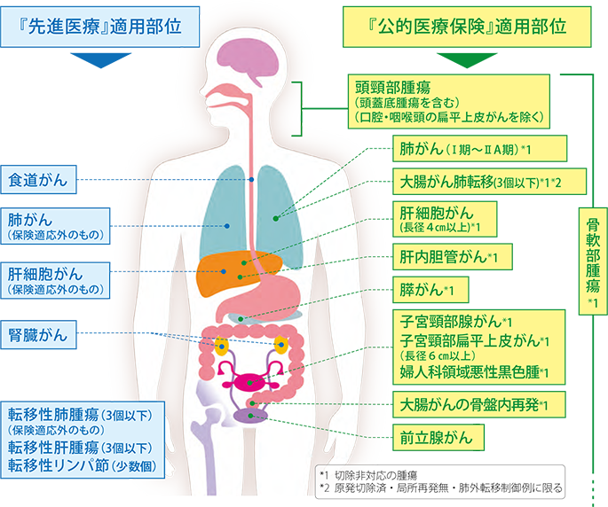重粒子線がん治療の対象となる部位